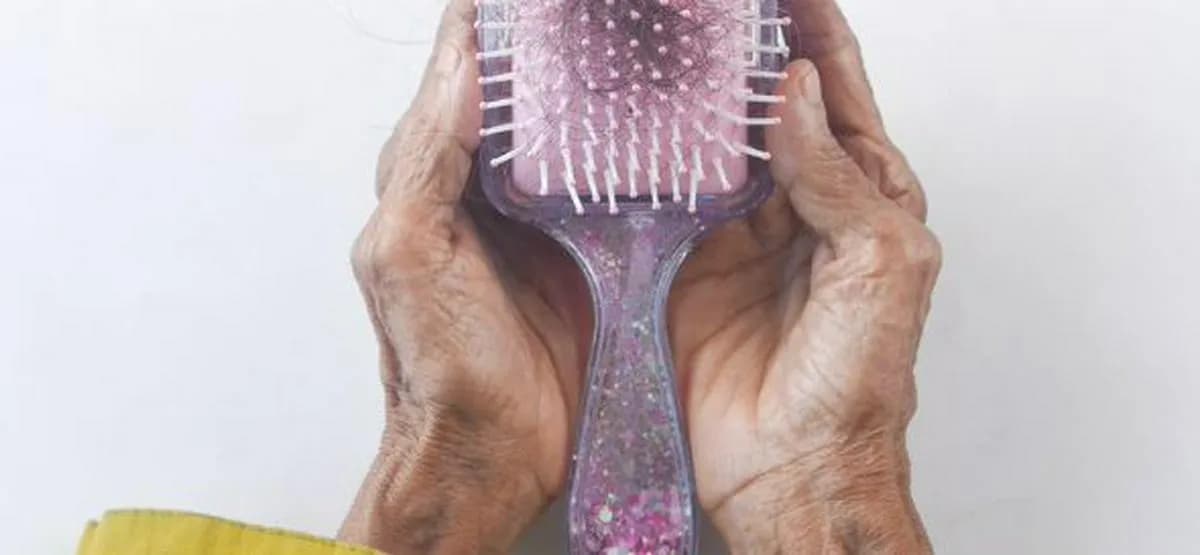 Alopecia: causas, tipos y recomendaciones de especialistas