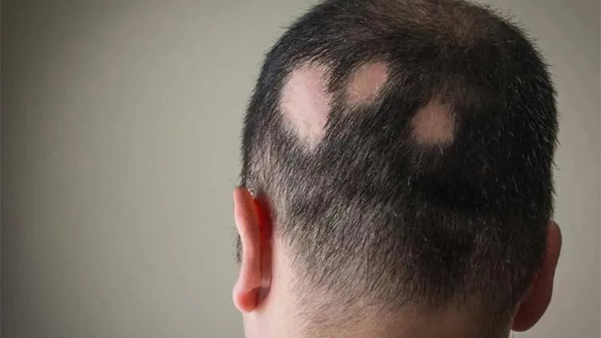 Nuevo tratamiento del upadacitinib muestra efectividad en alopecia areata