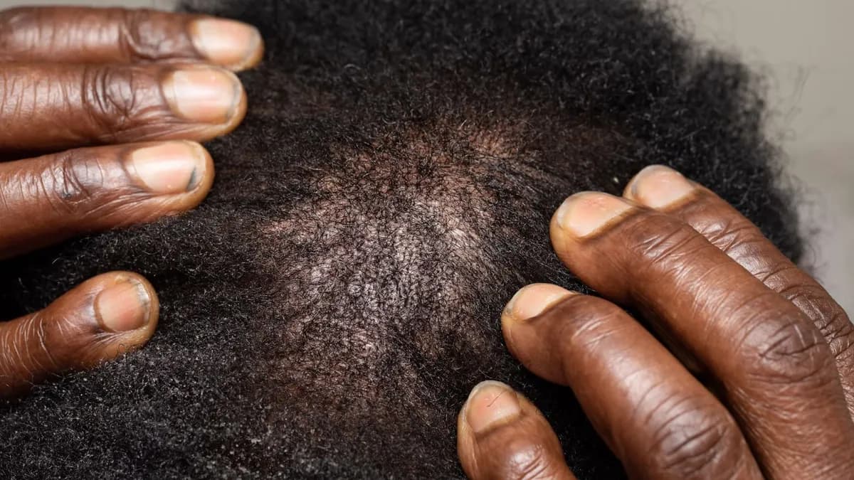 Alopecia androgenética: causas y tratamientos