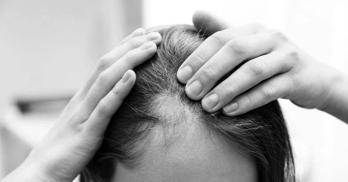 Un nuevo tratamiento para la alopecia areata severa muestra resultados prometedores