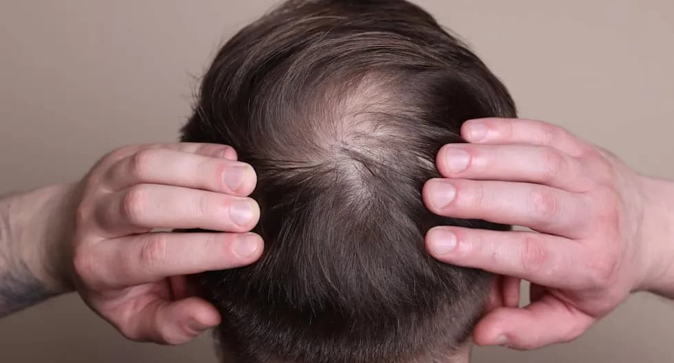 La genética y la caída del cabello: ¿Qué debes saber?