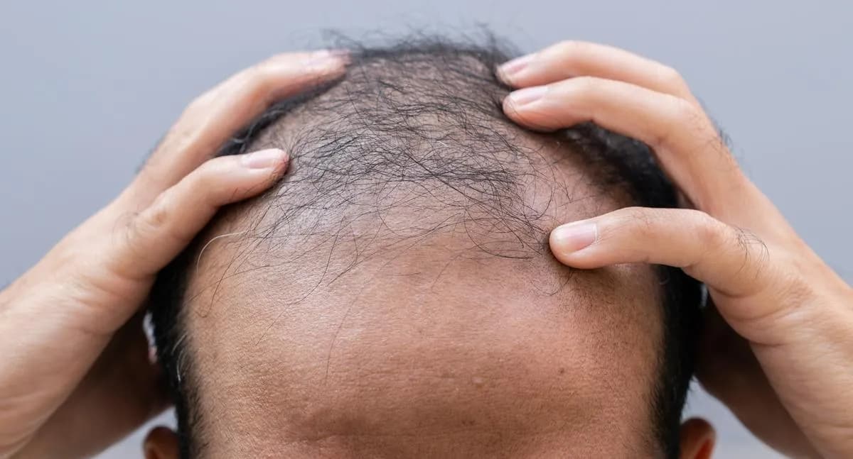 Bogotá ofrece jornada gratuita para evaluar la caída del cabello