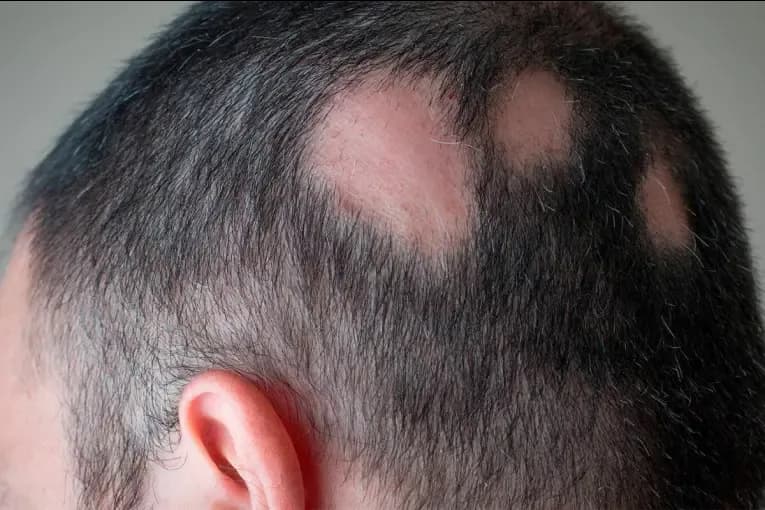 Un tratamiento para la artritis mejora la recuperación del cabello en alopecia areata grave