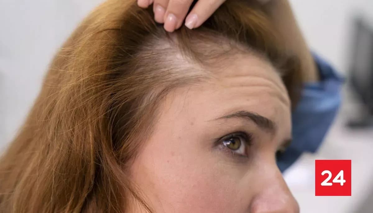 Upadacitinib: Claves sobre el tratamiento para la alopecia areata